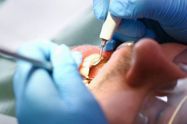 Best Emergency Wisdom Teeth Removal in Noank, CT